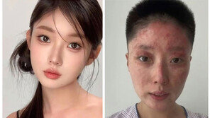 담뱃불에 가스 ‘펑’…전신화상 입은 中 뷰티 인플루언서